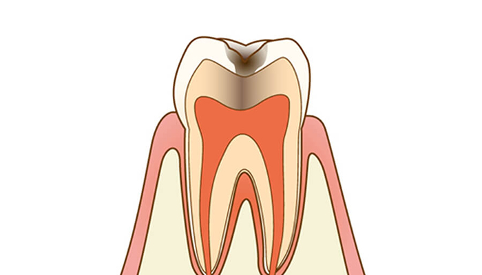 C2：感染歯質が表層のエナメル質を超え、2層目の象牙質内に入り込んだ状態